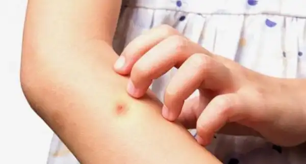 Як виявити укуси різних комах та коли варто звернутися за медичною допомогою 6